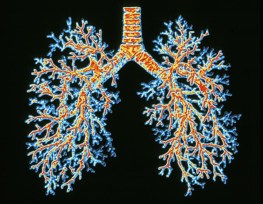 В легких имеются разветвления кровеносных сосудов. Бронхи альвеолярное дерево. Бронхиальное дерево фрактал. Бронхиальное дерево и легкие.