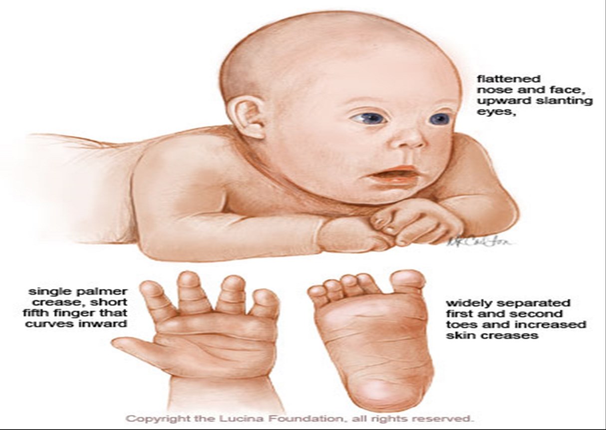 Признаки дауна у новорожденного. Синдром Дауна характерные черты. Симптомы синдрома Дауна у ребенка в год. Внешние проявления синдрома Дауна у новорожденных. Признаки синдрома Дауна у новорожденного внешние признаки.