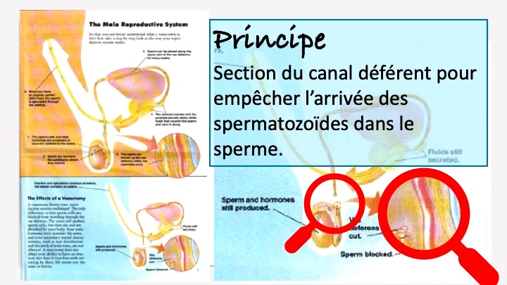 Vasectomie contraceptive : le principe de la vasectomie et la section du canal déférent pour empêcher l'arrivée des spermatozoïdes dans le sperme. Vasectomie Paris -  centre de vasectomie du Dr Hupertan